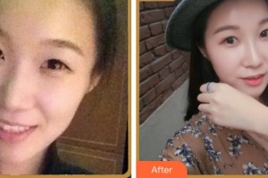 杭州整形醫(yī)院鄭群整形價格表附熱瑪吉案例展示