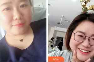 廣州市荔灣區(qū)口腔醫(yī)院司徒燕整形價(jià)格表附牙齒隱形矯正案例展示