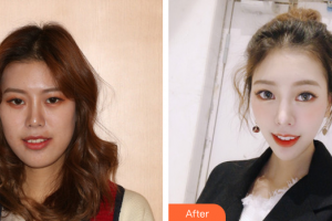 廣州市荔灣區(qū)口腔醫(yī)院吳海峰整形價(jià)格表附隱形托槽矯正案例展示