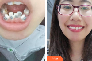 廣州市荔灣區(qū)口腔醫(yī)院曾慧儀整形價(jià)格表附牙齒矯正案例展示