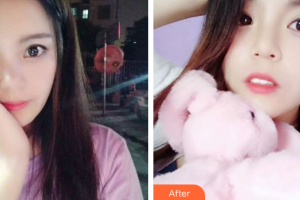 廣州市荔灣區(qū)口腔醫(yī)院莫閭妍整形價(jià)格表附牙齒隱形矯正案例展示