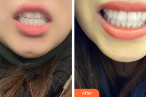 廣州嘉美口腔門診部朱衛(wèi)紅整形價(jià)格表附隱形托槽矯正案例展示