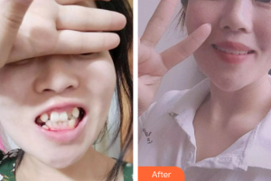 廣州市荔灣區(qū)口腔醫(yī)院魏鴻明整形價(jià)格表附牙齒矯正案例展示