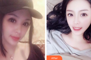 廣州梅里奧口腔門診部王鴻烈整形價(jià)格表附牙齒隱形矯正案例展示