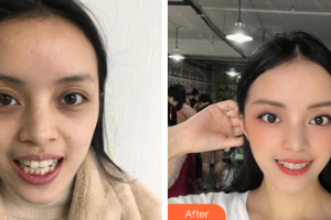 廣州市荔灣區(qū)口腔醫(yī)院鄒雙雙整形價(jià)格表附隱形牙齒矯正案例展示