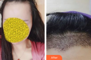 廣州美博匯醫(yī)療美容門診部趙新整形價(jià)格表附種植發(fā)際線案例展示