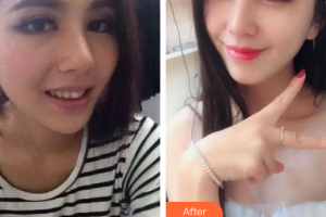 廣州宸山醫(yī)療美容門診部朱健海整形價(jià)格表附金屬托槽矯正案例展示