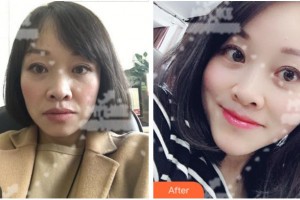 杭州啟美醫(yī)療美容醫(yī)院秦良忠整形價格表附埋線提升案例展示