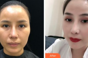 杭州啟美醫(yī)療美容醫(yī)院梁浩銘整形價格表附熱拉提案例展示