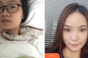 杭州啟美醫(yī)療美容醫(yī)院武安善整形價格表附熱瑪吉案例展示