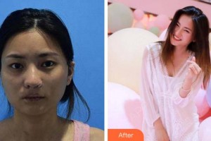 杭州啟美醫(yī)療美容醫(yī)院苗強整形價格表附埋線提升案例展示