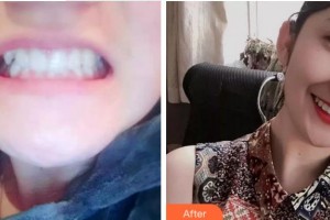 杭州市第一人民醫(yī)院醫(yī)學美容科李金晟整形價格表附牙齒陶瓷矯正案例展示