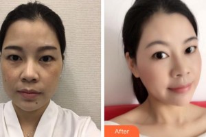 杭州啟美醫(yī)療美容醫(yī)院王盛波整形價格表附埋線提升案例展示