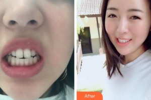 杭州藝星醫(yī)療美容醫(yī)院張鳴整形價格表附隱形托槽矯正案例展示