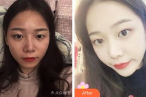 杭州維多利亞醫(yī)療美容醫(yī)院馬騰整形價(jià)格表附切開雙眼皮案例展示
