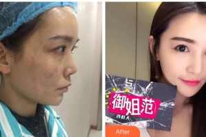 杭州維多利亞醫(yī)療美容醫(yī)院朱蕓整形價(jià)格表附激光祛斑案例展示