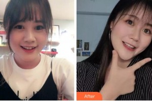 杭州維多利亞醫(yī)療美容醫(yī)院施長溪整形價(jià)格表附金屬托槽矯正案例展示