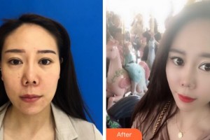 杭州維多利亞醫(yī)療美容醫(yī)院劉毅整形價(jià)格表附埋線提升案例展示