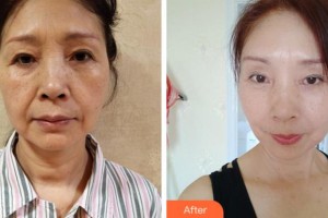 杭州東方整形外科門診部魏端欽整形價(jià)格表附埋線提升案例展示