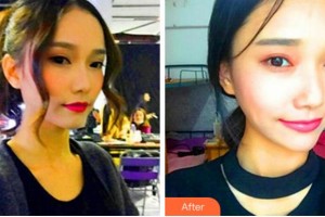 杭州格萊美整形美容醫(yī)院張龍整形價(jià)格表附熱瑪吉案例展示