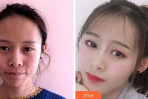 杭州維多利亞醫(yī)療美容醫(yī)院鐘鋒整形價格表附埋線提升案例展示