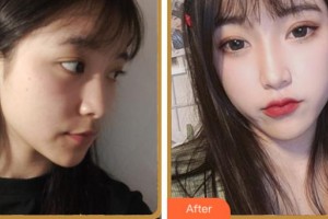 杭州顏術(shù)悅?cè)葆t(yī)療美容診所蘭巖菊整形價格表附埋線提升案例展示