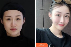 杭州顏術(shù)悅?cè)葆t(yī)療美容診所黃珊珊整形價格表附埋線提升案例展示