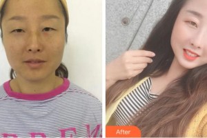 杭州黛雅醫(yī)療美容診所何冬梅整形價格表附內(nèi)切祛眼袋案例展示