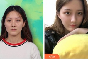 杭州昕微整形美容醫(yī)院漆淳整形價格表附內(nèi)切祛眼袋案例展示