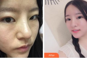 杭州格萊美整形美容醫(yī)院張霞飛整形價格表附切開雙眼皮案例展示