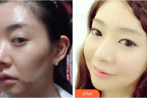 杭州麗星醫(yī)療美容診所金廷炫整形價格表附埋線提升案例展示