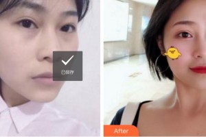 杭州麗星醫(yī)療美容診所汪世元整形價格表附埋線提升案例展示