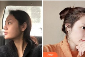 杭州解放軍第117醫(yī)院美容整形外科中心夏東勝整形價格表附假體隆鼻案例展示