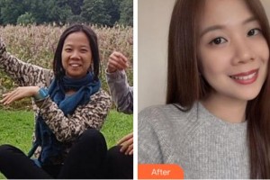 杭州達(dá)侖口腔門診部方朝榮整形價(jià)格表附金屬托槽矯正案例展示