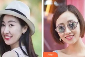 杭州美奧口腔門診部王明整形價(jià)格表附隱形托槽矯正案例展示