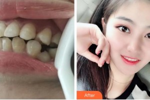 杭州美奧口腔門診部蔡明霏整形價(jià)格表附金屬托槽矯正案例展示