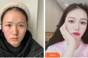 杭州富陽柏氏眼科醫(yī)院諸力偉整形價(jià)格表附眼部綜合案例展示