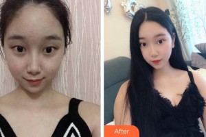 杭州求是眼科醫(yī)院顏偉年整形價(jià)格表附切開雙眼皮案例展示