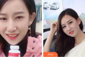 杭州協(xié)友口腔門診部金亭曼整形價(jià)格表附牙齒隱形矯正案例展示