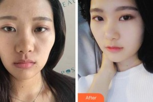 杭州嬋之媛醫(yī)療美容診所崔在爀整形價(jià)格表附熱瑪吉案例展示