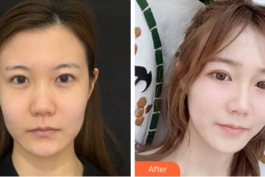 杭州嬋之媛醫(yī)療美容診所孫華昌整形價(jià)格表附熱瑪吉案例展示