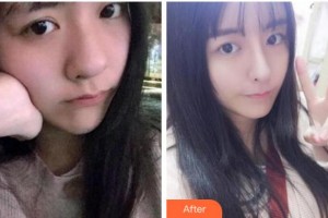 杭州依萱綺醫(yī)療美容診所周琦整形價(jià)格表附熱瑪吉案例展示