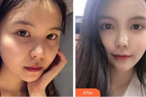 杭州依萱綺醫(yī)療美容診所李營整形價(jià)格表附熱瑪吉案例展示