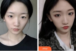 杭州華廈眼科醫(yī)院李夏珍整形價(jià)格表附切開雙眼皮案例展示