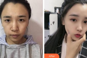 杭州華廈眼科醫(yī)院張宏亮整形價(jià)格表附眼部綜合案例展示