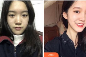 杭州華廈眼科醫(yī)院陳彬彬整形價(jià)格表附眼部綜合案例展示