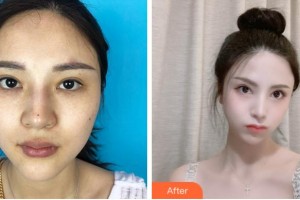 杭州安歆醫(yī)療美容醫(yī)院馮志丹整形價(jià)格表附下瞼整形案例展示