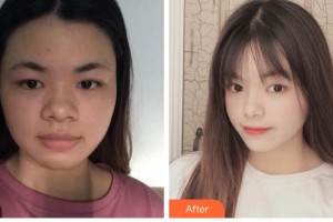 杭州睿妍醫(yī)療美容診所周蓉蓉整形價(jià)格表附埋線提升案例展示