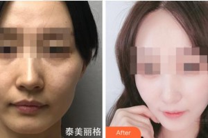 杭州睿妍醫(yī)療美容診所司婷婷整形價(jià)格表附熱瑪吉案例展示