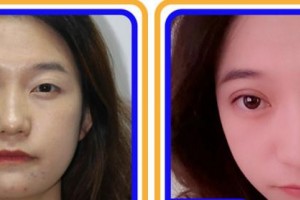 杭州來美安醫(yī)療美容門診部王恒整形價(jià)格表附眼部綜合案例展示